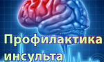 Профилактика инсульта